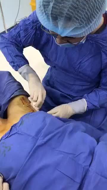 Kết thúc công nghệ Hút tuyến mồ hôi nách Endo Dry bằng qui trình băng ép cùng bác sĩ Kangnam