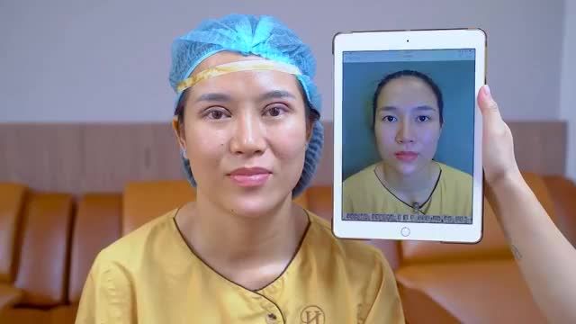 Bác sĩ làm việc xuyên trưa để mang đến cho khách hàng đôi mắt đẹp ngoài sự mong đợi sau khi cắt mí kết hợp mở góc mắt.!