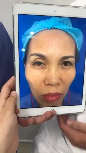 Kết quả ngay sau Cắt mí trên sửa lại+ cấy mỡ mí trên- cải thiện mí lỗi sau cắt mí tại Spa kém chất lượng