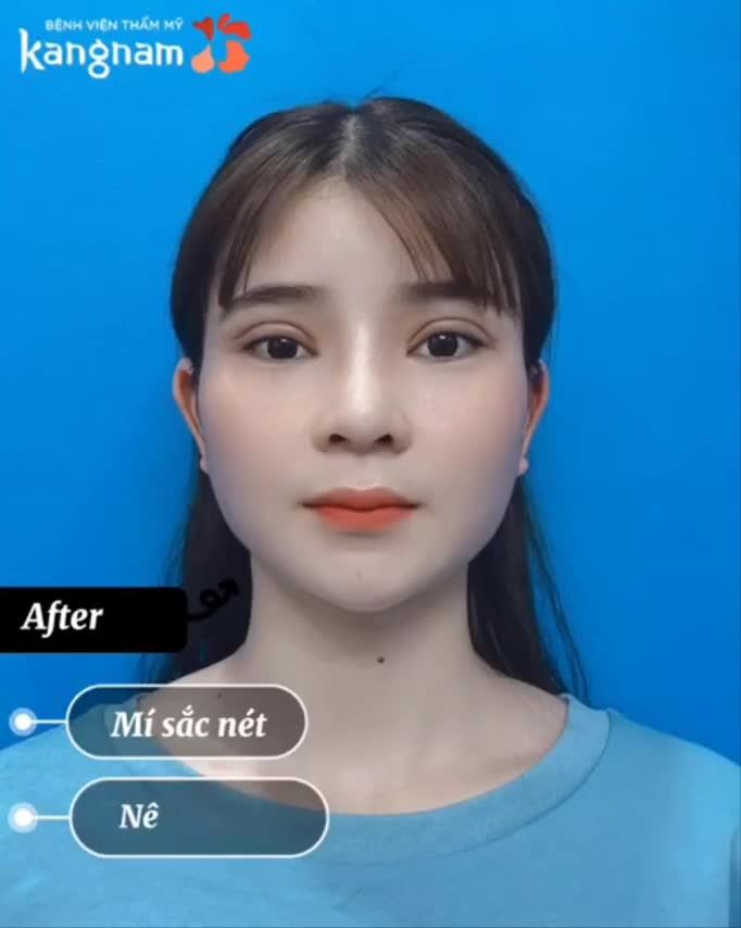 Hóa mĩ nữ sau Cắt mí Mí siêu tự nhiên