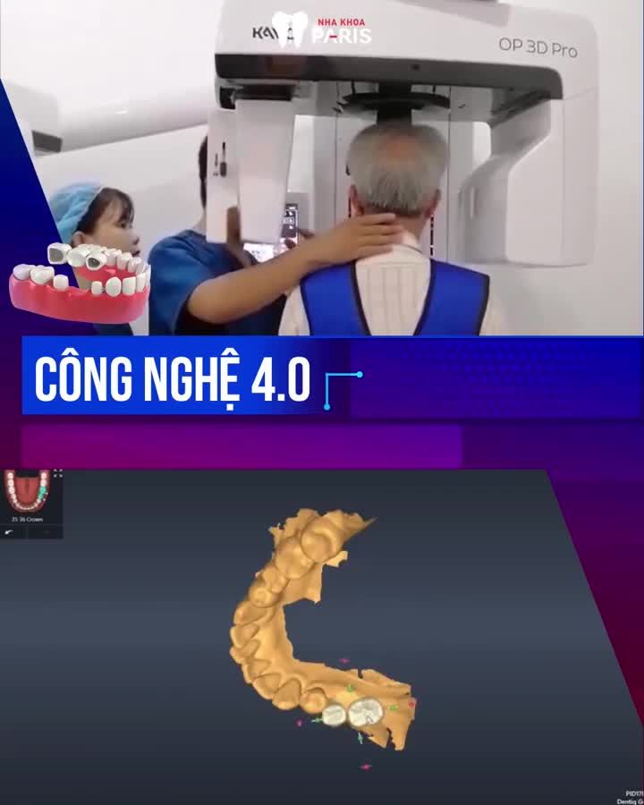 Mất 1 răng - Mất nhiều răng - Mất toàn hàm