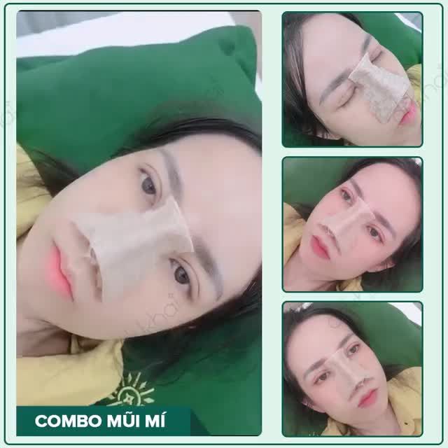 Điều gì đã thuyết phục những khách hàng khó tính đến thực hiện combo Nâng mũi + Cắt mí tại Bác sĩ  Đỗ Quang Khải?