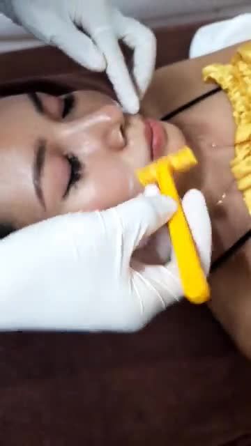 Khách hàng triệt ria mép bằng Công nghệ Diode Laser lần thứ 2 tại bệnh viện thẫm mĩ Kangnam