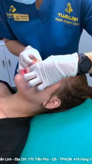 Khách hàng tái khám sau 10 ngày nâng mũi cấu trúc tại VTM Tuấn Linh.