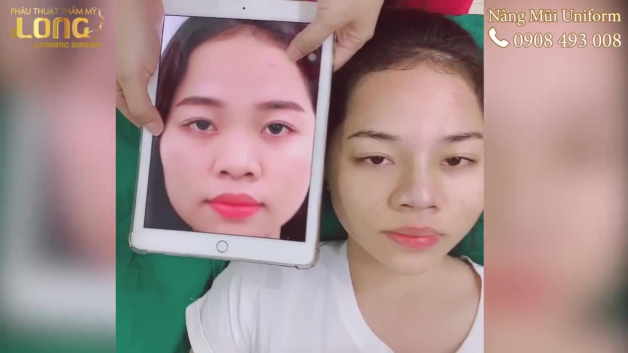Nâng Mũi Uniform - Dáng Mũi Tự Nhiên, Cao Thanh Tú