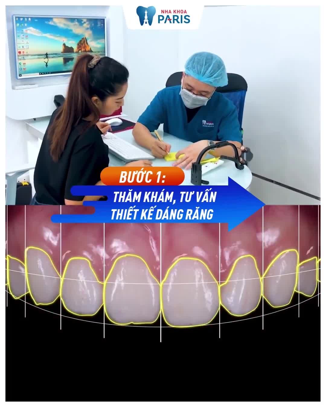 Răng Nhiễm Màu  - Ố Vàng, Vỡ, Mẻ - Thẩm mỹ kém