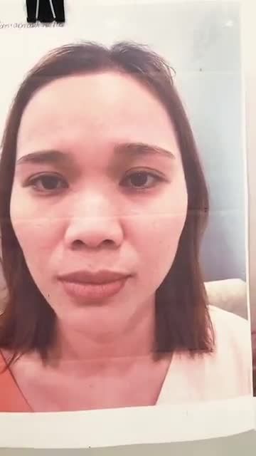 Khách hàng sóng mũi thấp, đầu mũi to, cánh mũi bè, da mỏng. Kh sử dụng pp cấu trúc sụn tai + Surgiform. Dáng mũi Sline cao
