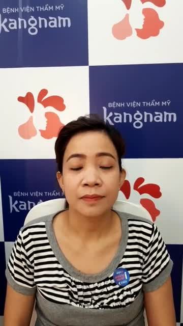 Tái khám sau 1 tháng Chỉnh hình sụp mí tại Kangnam  Kết quả quá BẤT NGỜ