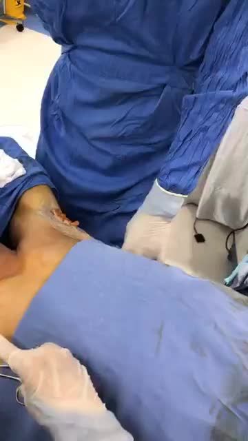 Cùng kết thúc quá trình hút tuyến mồ hôi nách Endo Dry nào