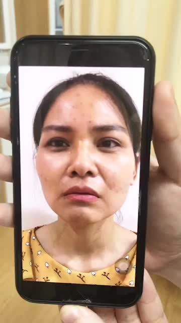 Da căng bóng trắng sáng sau 3 buổi  trị liệu hồi sinh da Rebon Skin