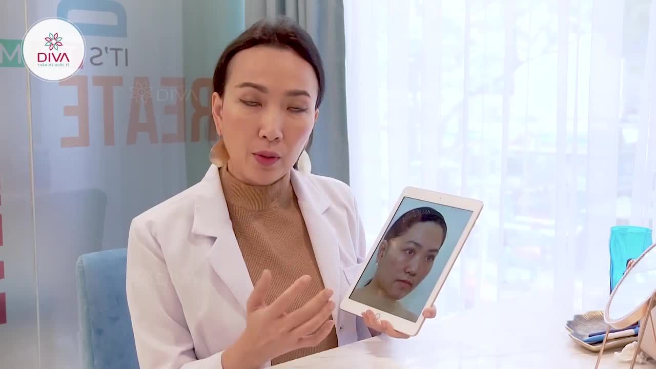 CẤY MỠ - GIẢI PHÁP CHO KHUÔN MẶT HỐC HÁC, KHUYẾT LÕM TRỞ NÊN ĐẦY ĐẶN, CÂN ĐỐI