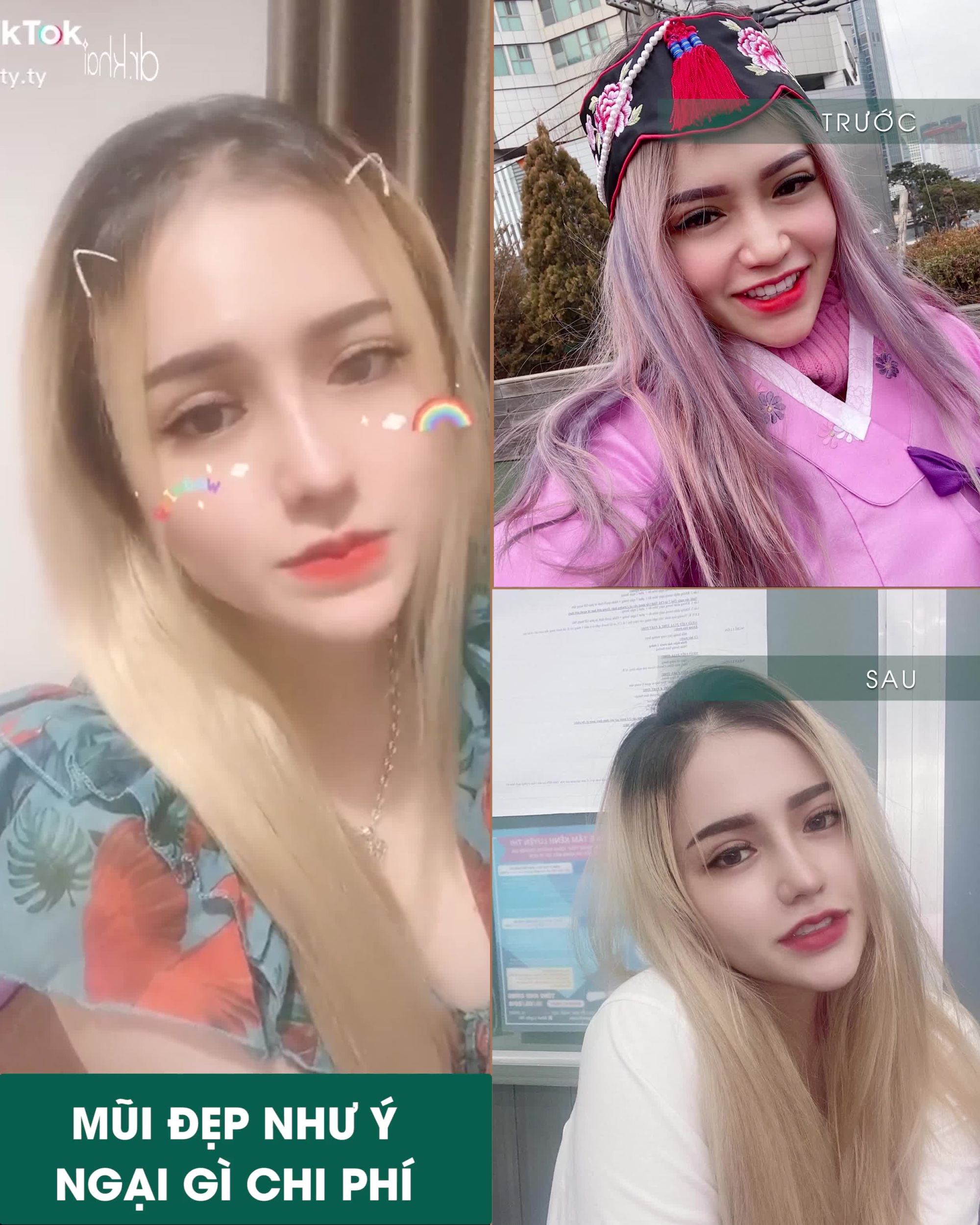 MŨI ĐẸP HẾT Ý - NGẠI GÌ CHI PHÍ