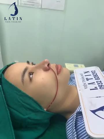 NÂNG MŨI BÁN CẤU TRÚC