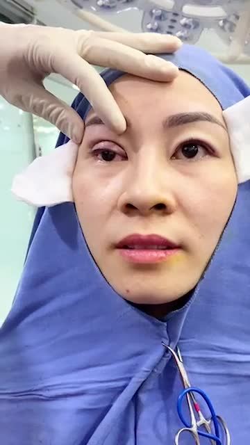 So sánh kết quả Cắt mí Plasma ngay trên bàn phẫu thuật - kết quả thay đổi rõ rệt sau 10p phẫu thuật