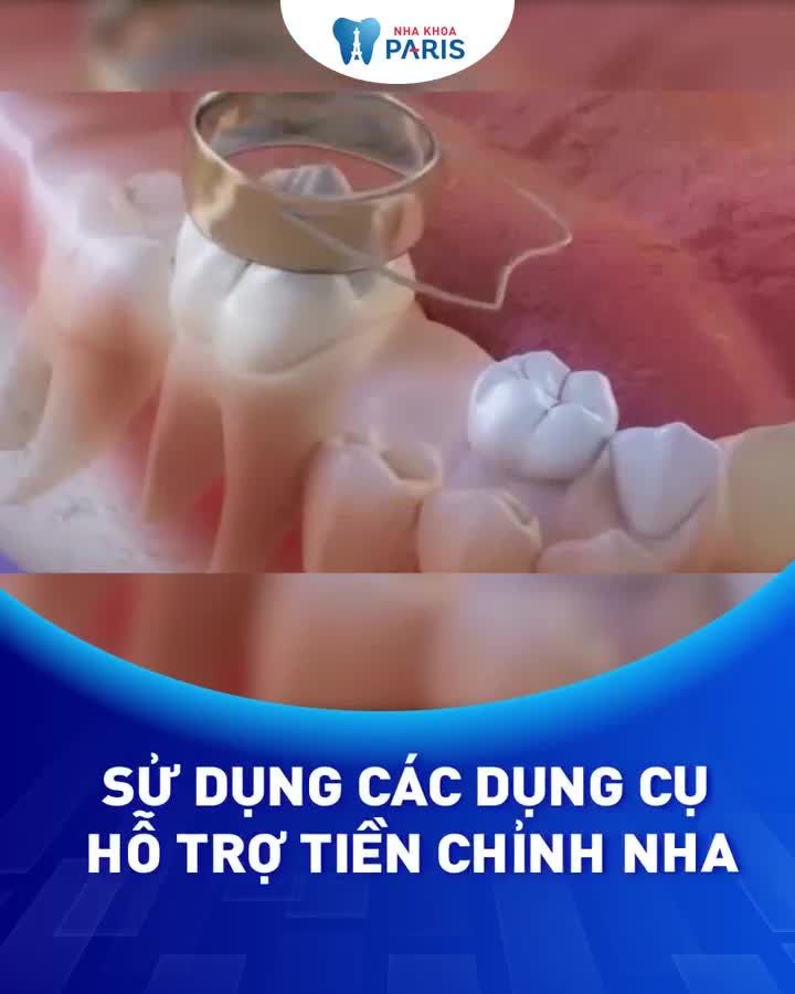 Con hết Hô - Móm -Thưa/Khấp khểnh rất sớm