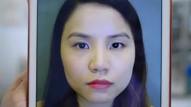 Tại sao kỹ thuật cắt mí tại Dr.Hải Lê ngay sau khi thực hiện rất ít sưng đau hay tím bầm?