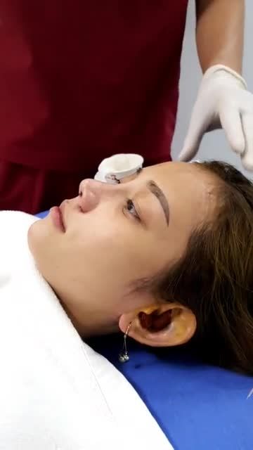 DÁNG MŨI NGAY SAU PHẪU THUẬT
