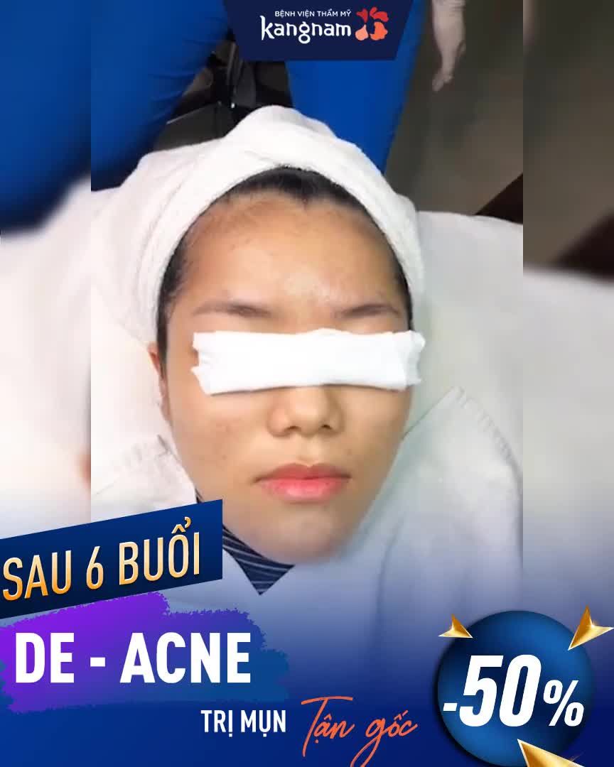 Sau 6 BUỔI  Thoát ngay MỤN VIÊM, MỤN BỌC