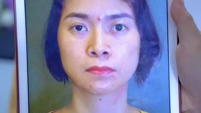 Giải cứu thành công ca mí lỗi hỏng 3 lần do cắt mí tại cơ sở không uy tín.