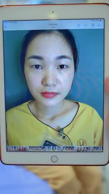 Cắt mí ít sưng, ít đau, không bầm tím và không cần nghỉ dưỡng không chỉ dựa vào kỹ thuật thực hiện mà còn dựa vào tay nghề bác sĩ giỏi chuyên môn cao