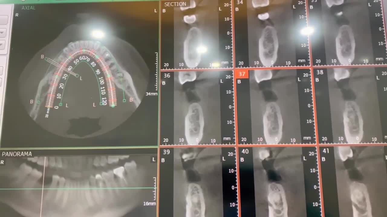 AN TÂM PHỤC HÌNH RĂNG ĐÃ MẤT CÙNG CHUYÊN GIA IMPLANT