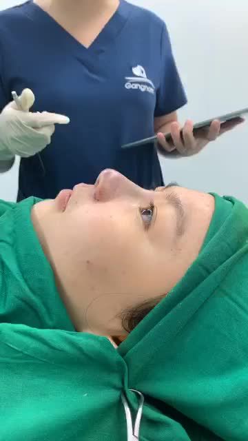 Dáng mũi bọc sụn cao tự nhiên, gom cánh mũi thon gọn ngay sau phẫu thuật nhà Gangwhoo