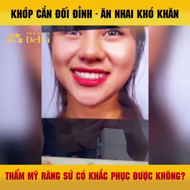 KH Diệu Hằng đến với Delia trong tình trạng  khớp cắn đối 1đỉnh dẫn tới sứt mẻ rìa cắn, ăn nhai khó khăn