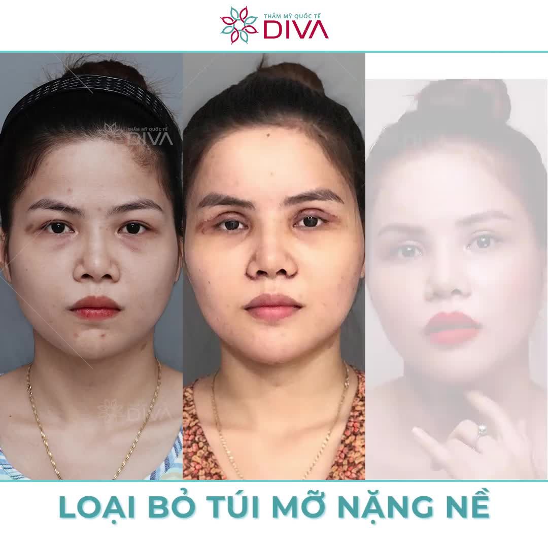 KHI NÀO CẦN THẨM MỸ MẮT ?