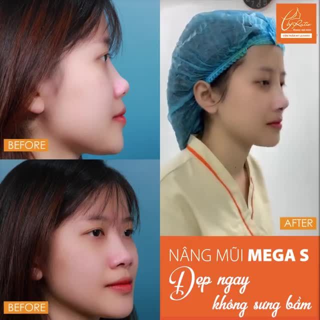 SAU KHI NÂNG MŨI MEGA S TẠI LA RATIO SẼ NHƯ THẾ NÀO?