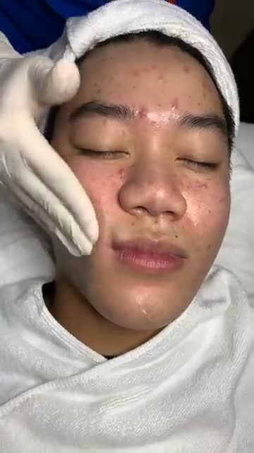 Trị mụn - Giá tốt nhất  CHỈ TỪ 99K