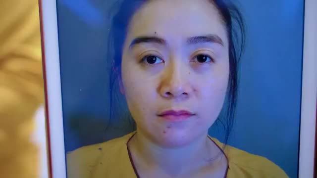 GIẢI CỨU thành công ca mí lỗi hỏng thành công cho vị khách đến từ Đắk Lăk bằng kỹ thuật DeepTech20
