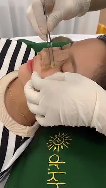 Cận cảnh tháo nẹp, vệ sinh mũi ĐÚNG CHUẨN sau khi nâng tại trung tâm