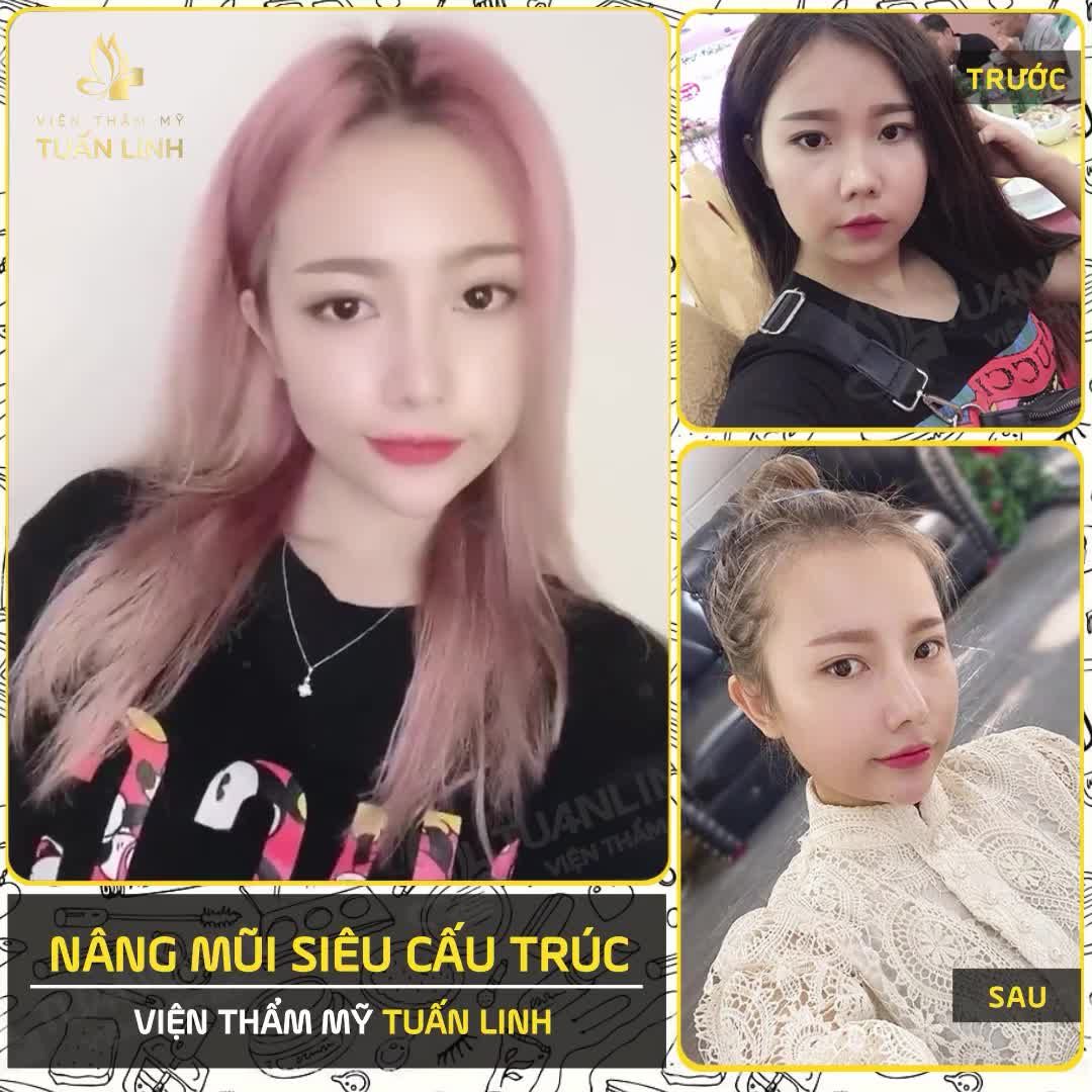 Mũi xấu quá chỉ cần " nâng nhẹ" lên một cái - Như bạn khách hàng nhà Tuấn Linh này- Đã là cả một sự thay đổi NGOẠN MỤC rồi.