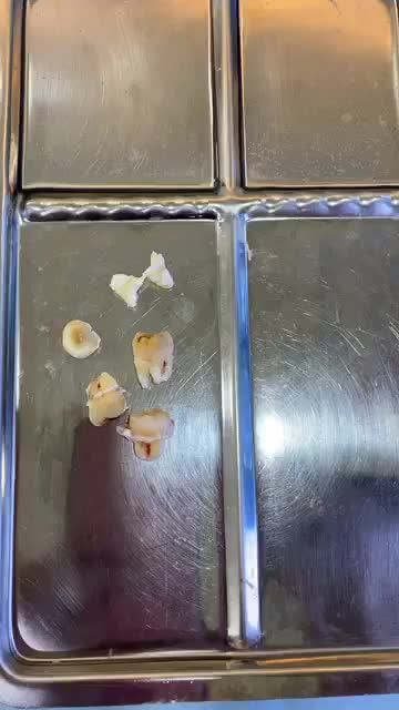 Nhổ răng số 8 có đau không? 15 phút diệt gọn 4 răng khôn và cảm nhận thực tế của khách hàng