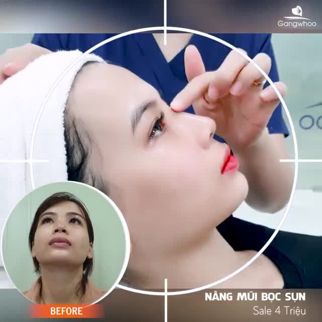 TÙY CHỈNH DIỆN MẠO - MŨI ĐẸP CHUẨN HÀN