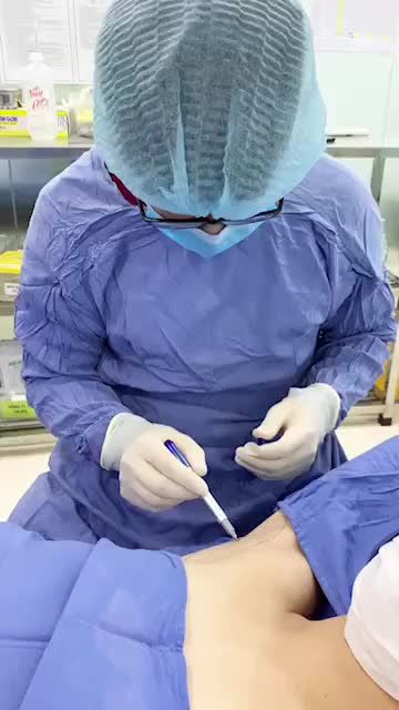 Quy trình hút tuyến nội soi - loại bỏ nùi hôi khó chịu 1 lần duy nhất