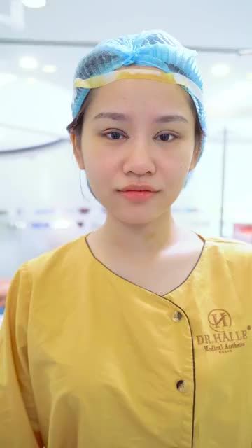 Mắt đẹp xuất sắc ngoài sự mong đợi chỉ sau 45 phút thực hiện Cắt mí tại Dr.Hải Lê