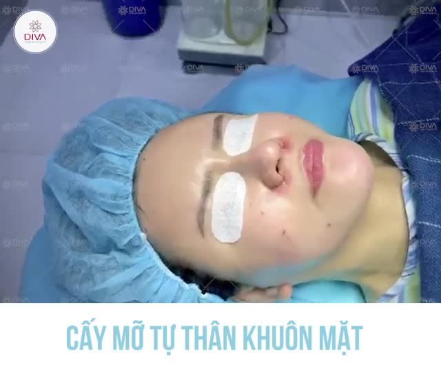 CẤY MỠ MẶT CÓ NHỮNG LỢI ÍCH GÌ ?