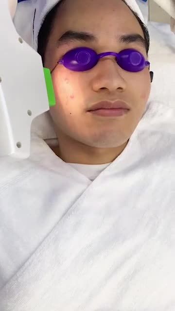 "Quét sạch" tình trạng “Siêu Mụn” sau b5 buổi điều trị mụn De-Acne tại Kangnam
