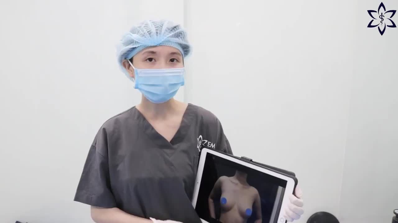 VIỆC CẤY MỠ TỰ THÂN SAU KHI ĐẶT TÚI NGỰC CÓ ẢNH HƯỞNG NHƯ THẾ NÀO ĐỐI VỚI THẨM MỸ NGỰC?
