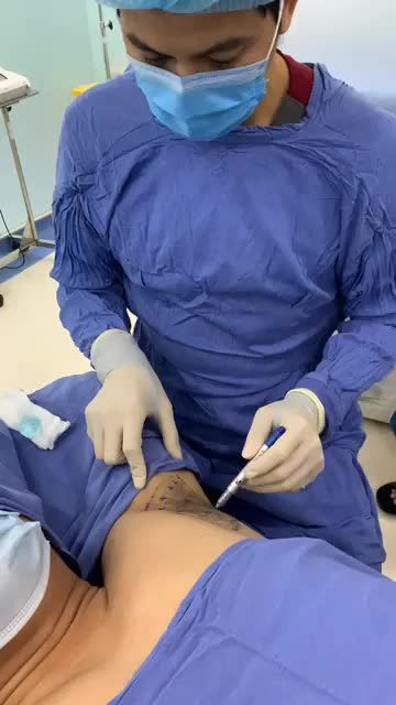 Quy trình điều trị hôi nách bằng công nghệ ENDO DRY tại Kangnam