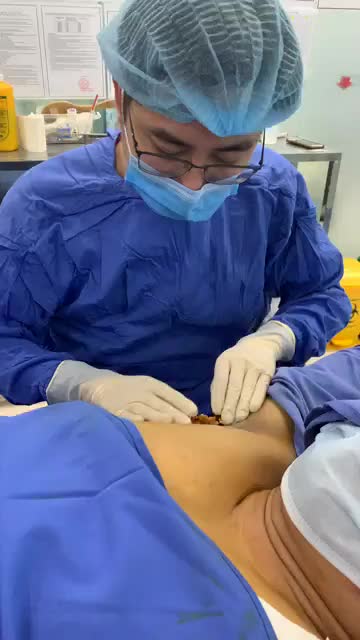Quá trình quan trọng nhất trong điều trị hôi nách bằng hút tuyến mồ hôi nách tại Bệnh viện thẩm mỹ Kangnam