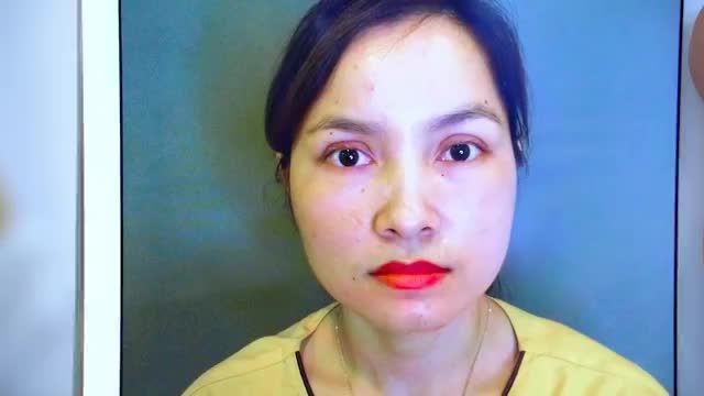 Tiếp tục "GIẢI CỨU" ca mí mắt lỗi hỏng do thực hiện ở cơ sở không uy tín