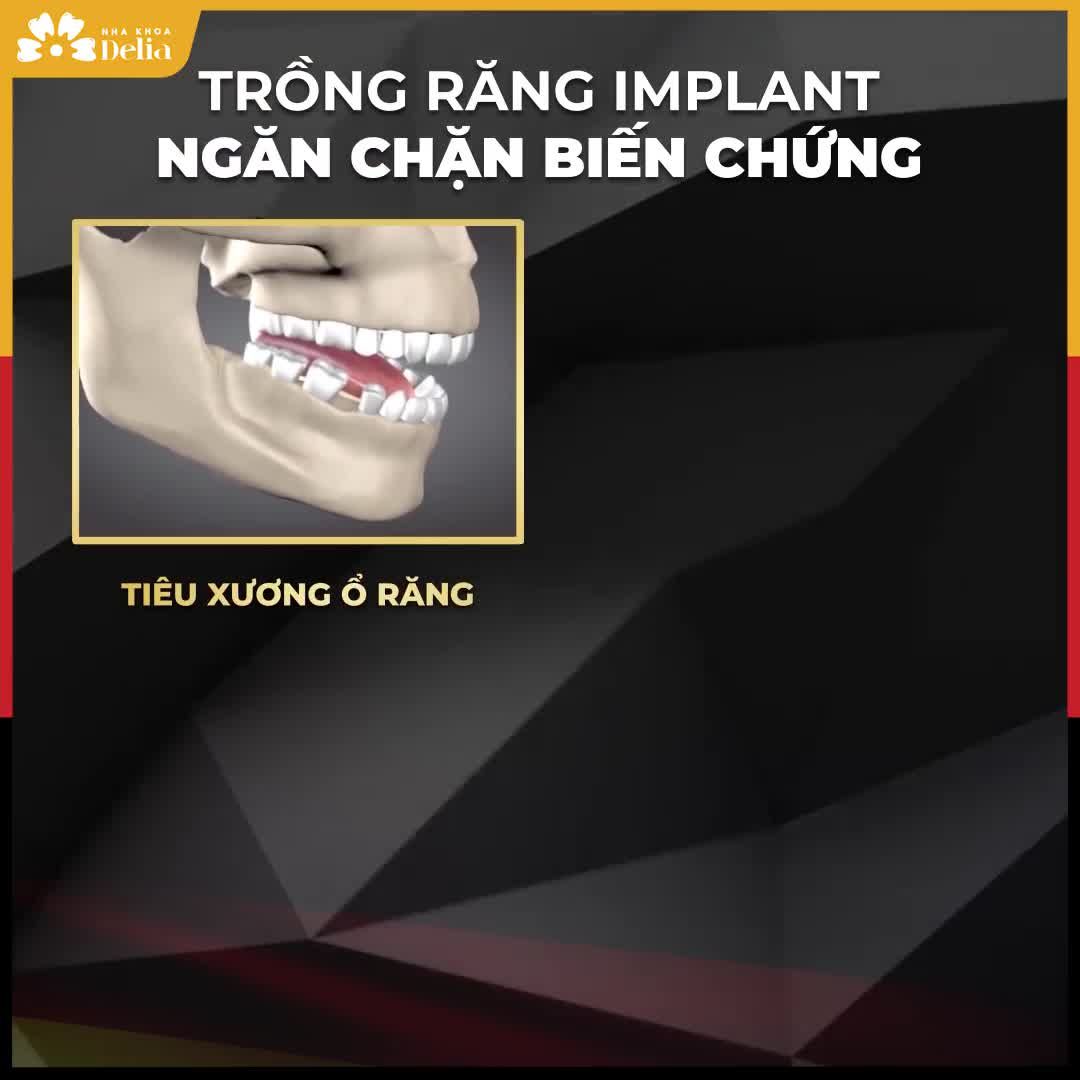 TẠI SAO PHẢI TRỒNG RĂNG IMPLANT