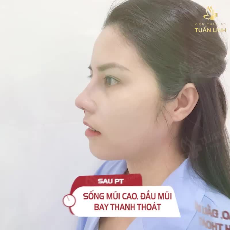 CHƯA BAO GIỜ CÓ Ý ĐỊNH NÂNG MŨI... CHO ĐẾN KHI !