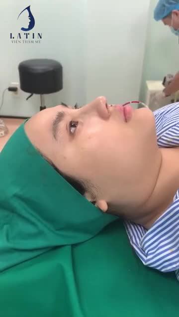 Mũi bán cấu trúc dáng Sline tự nhiên