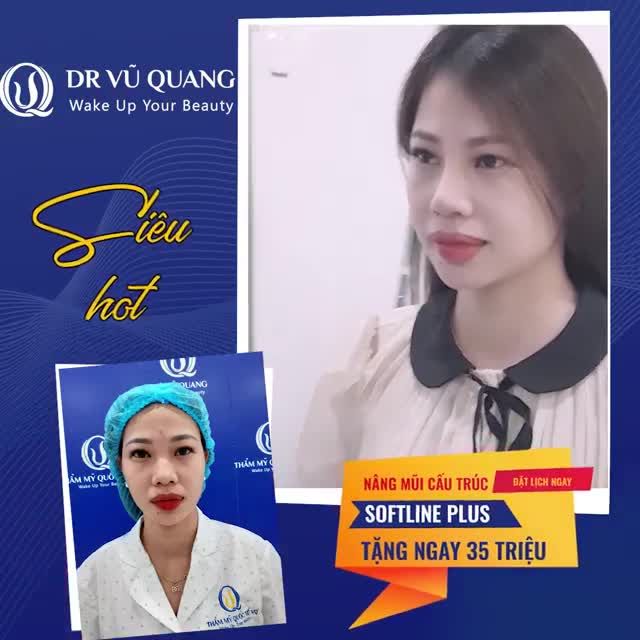Nâng mũi CẤU TRÚC SOFTLINE PLUS