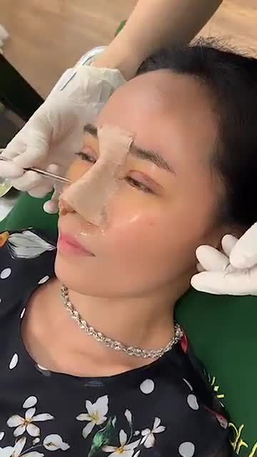 Nâng mũi cấu trúc và cắt mí sau 5 ngày