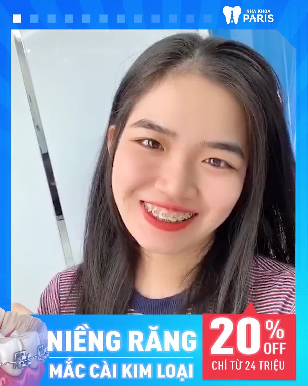 Niềng Răng Đều Đẹp Sau 6 Tháng