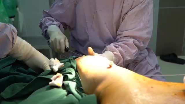 QUY TRÌNH HÚT MỠ BẮP TAY SIÊU NHẸ NHÀNG, KHÔNG CHẢY MÁU VỚI BỘ ĐÔI VASER LIPO POWER X